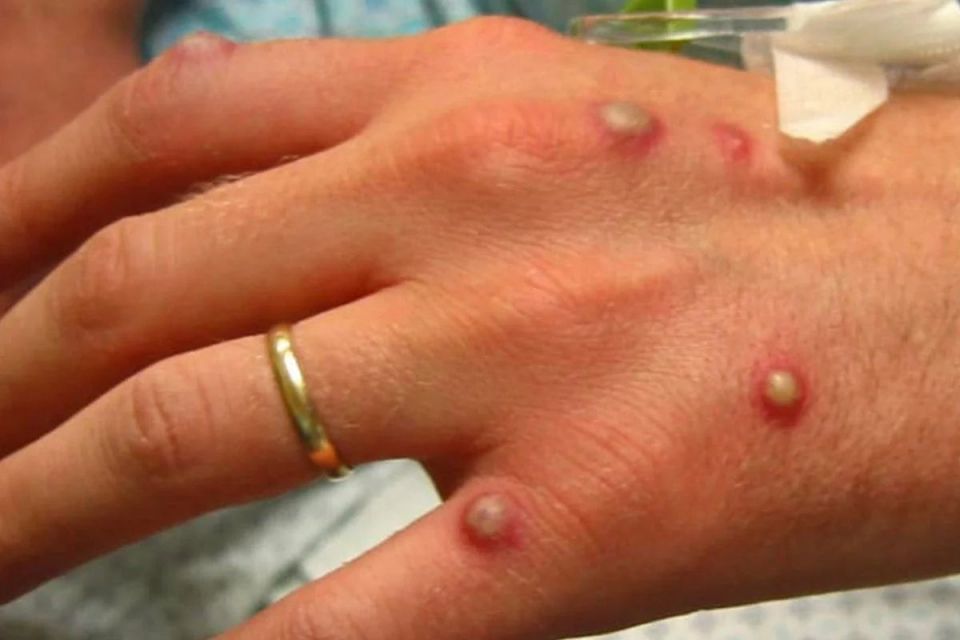 В Україні зареєстрували перший випадок віспи мавп. Що потрібно знати про епідемію?