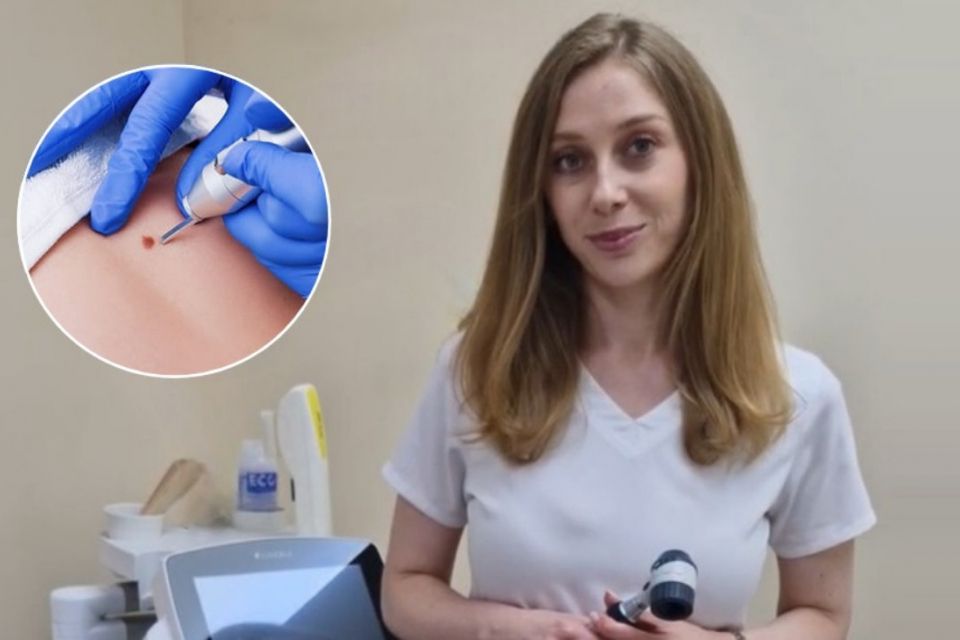 Що варто знати про родимки та де у Вінниці їх видаляють — пояснює дерматолог Катерина Юзвак
