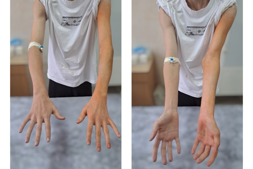 Ювелірна робота хірургів. У Вінниці врятували руку підлітка після надскладної травми ліктя