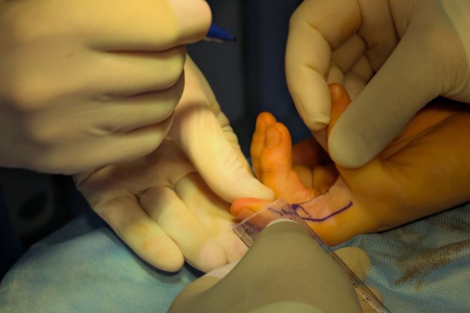 Рубцеві зміни після опіку: у Вінниці лікарі повернули рухливість пальців дев’ятирічному хлопчику