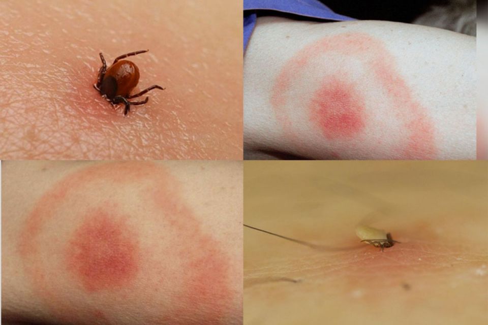Кліщі активізувалися. Яка ситуація з хворобою Лайма на Вінниччині та як вберегтися
