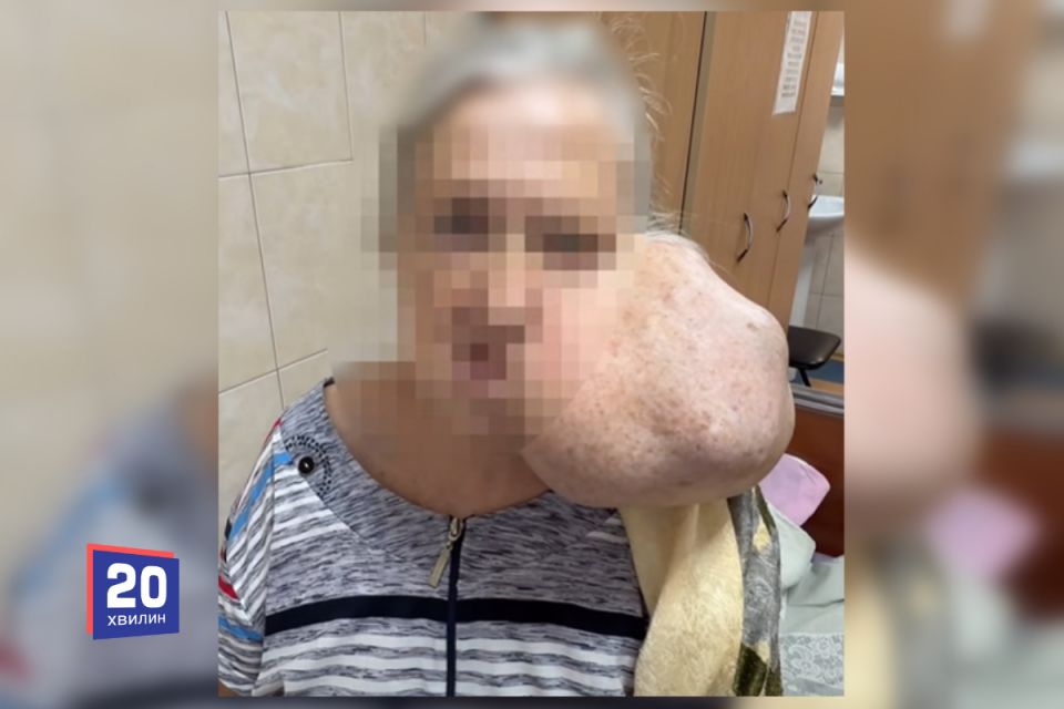 Пухлина розміром 30 сантиметрів, яка росла 20 років: унікальну операцію провели у Вінниці