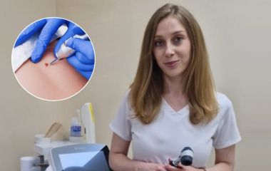 Що варто знати про родимки та де у Вінниці їх видаляють — пояснює дерматолог Катерина Юзвак