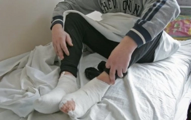 Є випадки ампутацій у п'яних і безхатьків: лікарі розповідають, хто найбільше страждає від обмороження