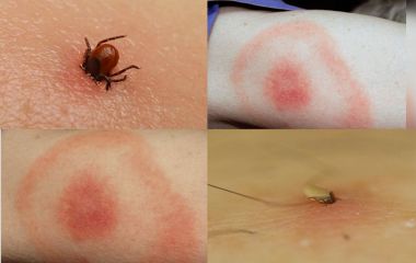 Кліщі активізувалися. Яка ситуація з хворобою Лайма на Вінниччині та як вберегтися