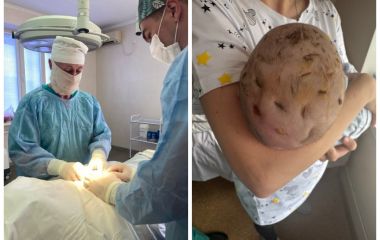 Гнійне запалення голови загрожувало життю тримісячного малюка. Лікарі провели термінову операцію