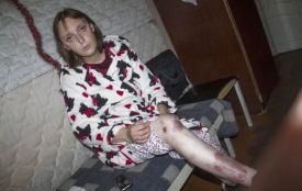 «Шкірвендиспансер закрили, а в мене знову загострення». Де лікуватись унікальним хворим?