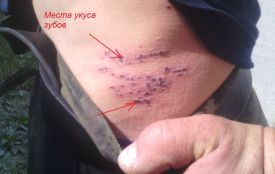 «Стан на межі смерті»: у соцмережах пишуть, що у центрі Вінниці чоловіка вкусила змія