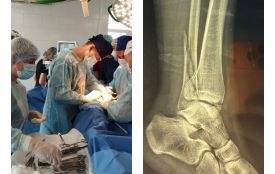 Небезпечний самокат: травматологи Вінниці врятували ногу підлітку, що отримав три складні переломи