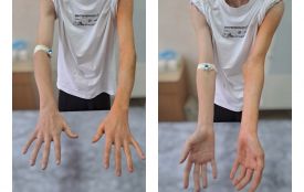 Ювелірна робота хірургів. У Вінниці врятували руку підлітка після надскладної травми ліктя