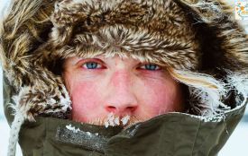 Алергія на холод: чому зима стає випробуванням для шкіри? Пояснюють лікарі