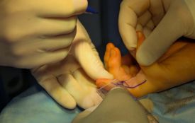 Рубцеві зміни після опіку: у Вінниці лікарі повернули рухливість пальців дев’ятирічному хлопчику