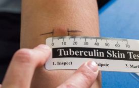 Манту більше не буде. Як тепер діагностуватимуть туберкульоз