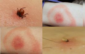 Кліщі активізувалися. Яка ситуація з хворобою Лайма на Вінниччині та як вберегтися