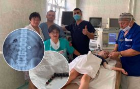 П’ять років у організмі дитини залишалися магніти: вінницькі лікарі видалили дев’ять кульок