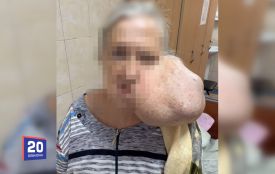 Пухлина розміром 30 сантиметрів, яка росла 20 років: унікальну операцію провели у Вінниці