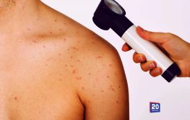 Безболісні «шишки» на шиї чи під пахвою? Які ознаки можуть вказувати на лімфому