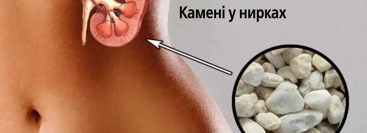 Камені у нирках - чи насправді це так ВАЖКО? (Новини компаній)