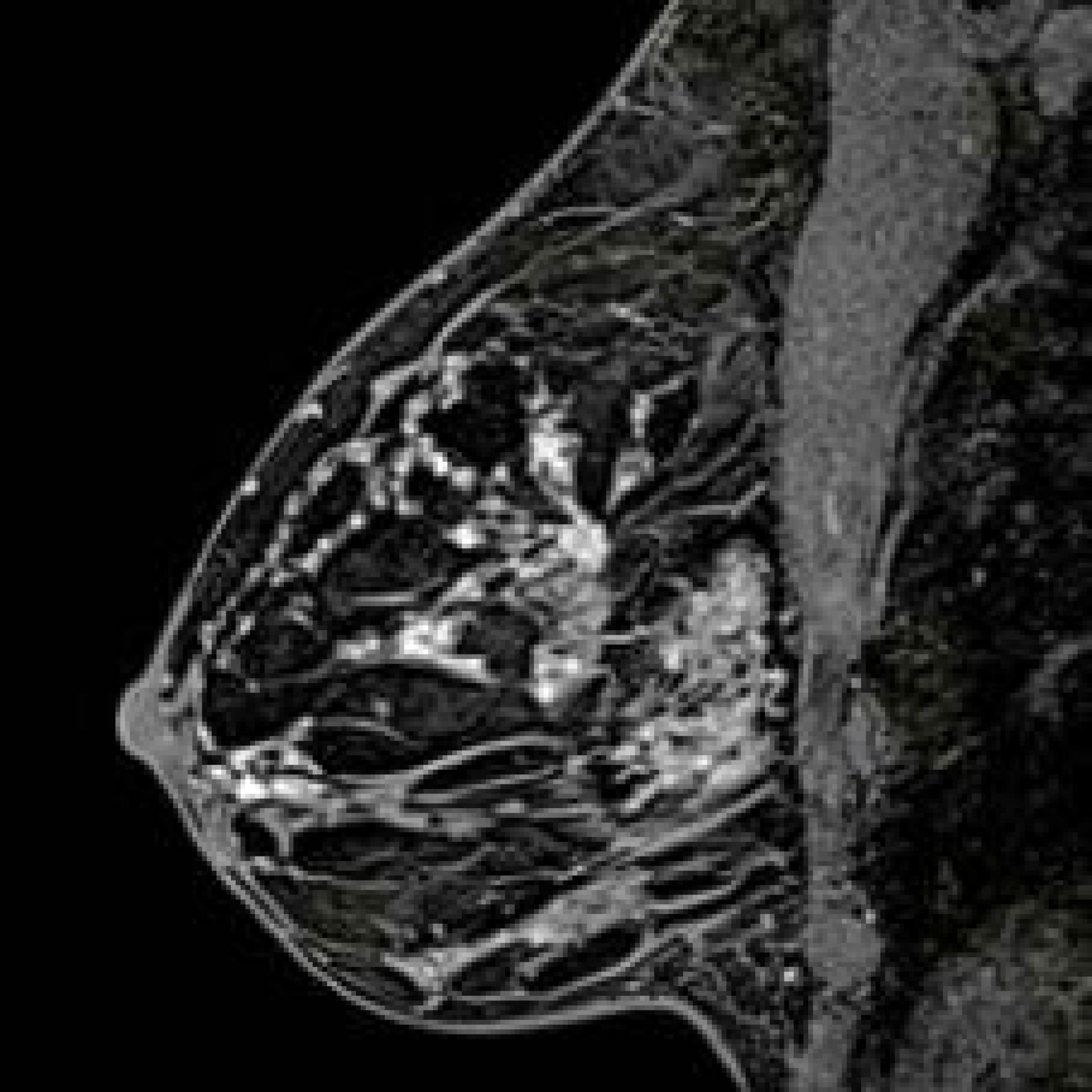 Маммография ростов на дону. Склерозирующий аденоз маммография. Магнитно резонансная томография молочной железы. Липома молочной железы рентген.